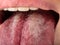 tongue with stomatitis close up, oral cancer
