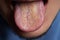 tongue with ulcers of adult man.Cracks in the tongue of a young man.man with halitosis for candida albicans on tongue.