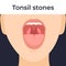 Tonsil stones, woman