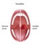 Tonsillitis