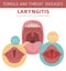 Tonsils and throat diseases. Laryngitis symptoms, treatment icon set. Medical infographic design