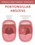 Tonsils and throat diseases. Peritonsillar abscess symptoms, treatment icon set. Medical infographic design