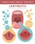 Tonsils and throat diseases. Peritonsillar abscess symptoms, treatment icon set. Medical infographic design.