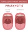 Tonsils and throat diseases. Pharyngitis symptoms, treatment icon set. Medical infographic design.