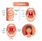 Tonsils vector illustration. Tonsillitis labeled structure diagram.