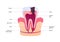 Tooth anatomy and decay chart. Vector biomedical illustration. Cross section with text isolated on white background. Inner teeth