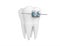 Tooth with braces isolated on white. Health, medical, tooth doctor, dental clinic or dentist symbol. 3d render