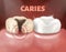 Tooth with caries and healthy tooth. 3d realistic illustration of dental disease. Deep caries on a sick tooth