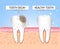 Tooth with caries and healthy tooth. Visual assistance to students, dentists, patients of the clinic. Defeat is a source of destru