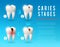 Tooth decay 3d poster of dental caries development