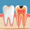 Tooth decay anatomy poster.  Enamel and dentin caries