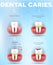 Tooth decay formation poster