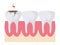 Tooth decay in mouth schematic cartoon on white
