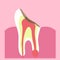 Tooth and deep caries on it on a pink background.