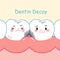 Tooth with dentin decay