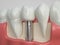 Tooth human implant - 3D Rendering