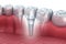 Tooth human implant