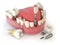 Tooth human implant. Dental concept. Human teeth or dentures.