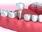 Tooth human implant, Medically accurate