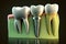 Tooth implant. Dental concept