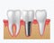 Tooth implant. Human teeth and dental implant, denture orthodontic technology. Artificial teeth dentistry implantation