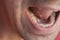 A tooth in a man's mouth with a temporary filling seal, closeup view.