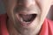 A tooth in a man's mouth with a temporary filling seal, closeup view.