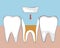 Tooth microprosthetics, Flat vector stock illustration with Canal treatment, molar depulpation and Ceramic orthodontic inlay