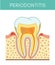 Tooth with periodontitis