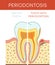 Tooth with periodontosis