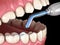 Tooth restoration with filling and polymerization lamp. Medically accurate tooth illustration