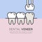 tooth veneer pictures