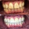 tooth veneers pictures