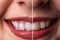 Tooth whitening