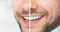 tooth whitening compare pictures