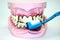 Toothbrush cleaning wooden dentures with caries and cavities on white background with copy space.  Dental Health care