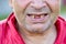 Toothless Caucasian middle aged man, lower part of face close up.