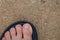 Top view of feet and skin on toes with toenails and ingrown toenail ulcers