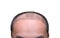 Top view of a man`s head with hair transplant surgery with a receding hair line