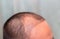 Top view of a man`s head with hair transplant surgery with a receding hair line