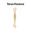 Torus fracture Bone. Infographics. Vector illustration on a lined background.