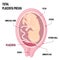 Total Placental previa. Dangerous Placenta Location During Pregnancy. Medical Pathology. detailed medical diagram with