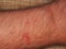 Traces of bites of blood-sucking insects (mosquitoes, horseflies) on human skin