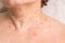 Traces of removal of papillomas on the neck of a woman_