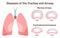 Tracheobronchomalacia. Airway and bronchial tubes disease. Soft and weak trachea