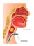 Tracheotomy