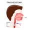 Tracheotomy. side view of the neck and the correct placement of a tracheostomy tube