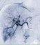 Transarterial Chemoembolization (TACE).