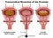 Transurethral Resection 3d illustration medical vector infographic with english description