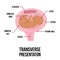 transverse baby presentation. wrong baby positions in uterus during pregnancy. Colored medical vector illustration.